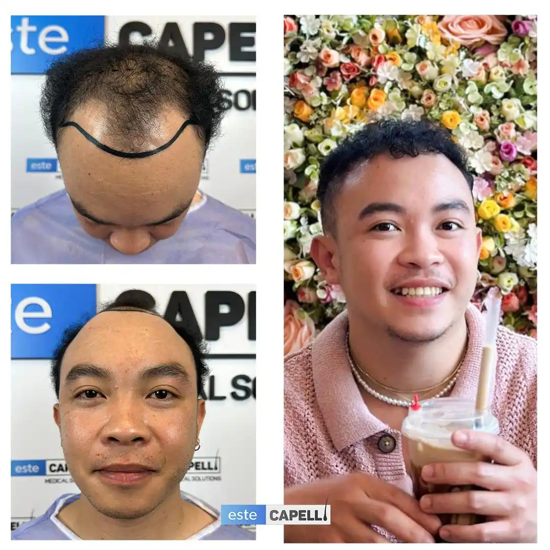 Antes y después trasplante capilar