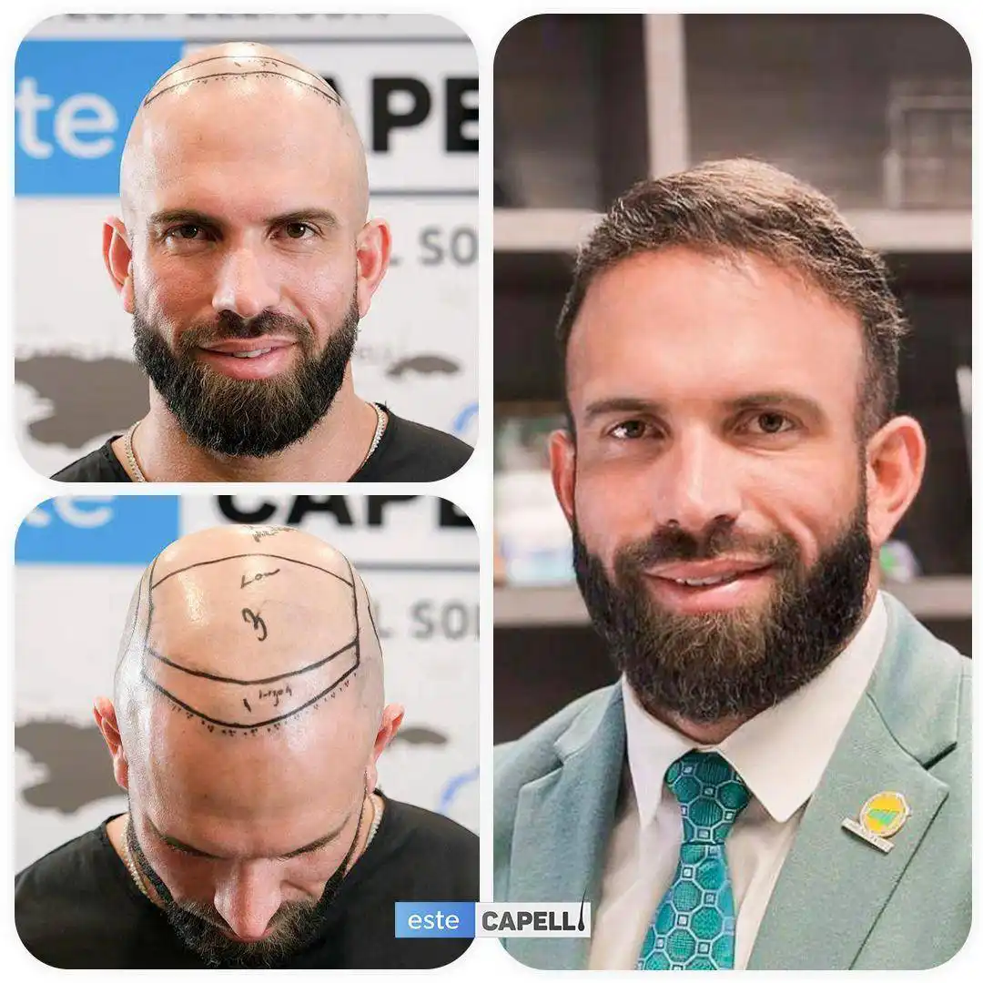 Antes y después trasplante capilar