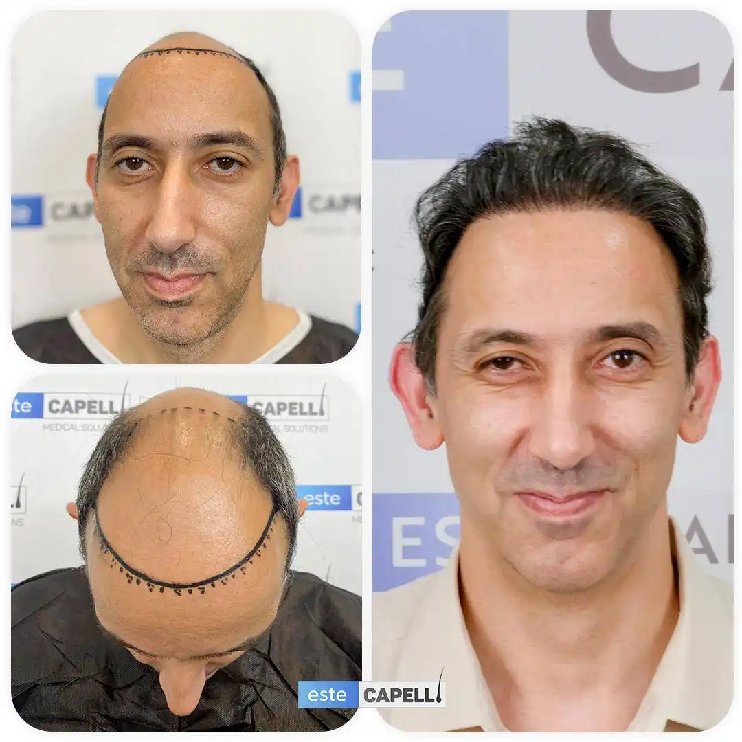 Antes y después trasplante capilar