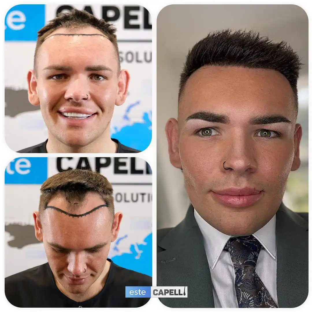 Antes y después trasplante capilar