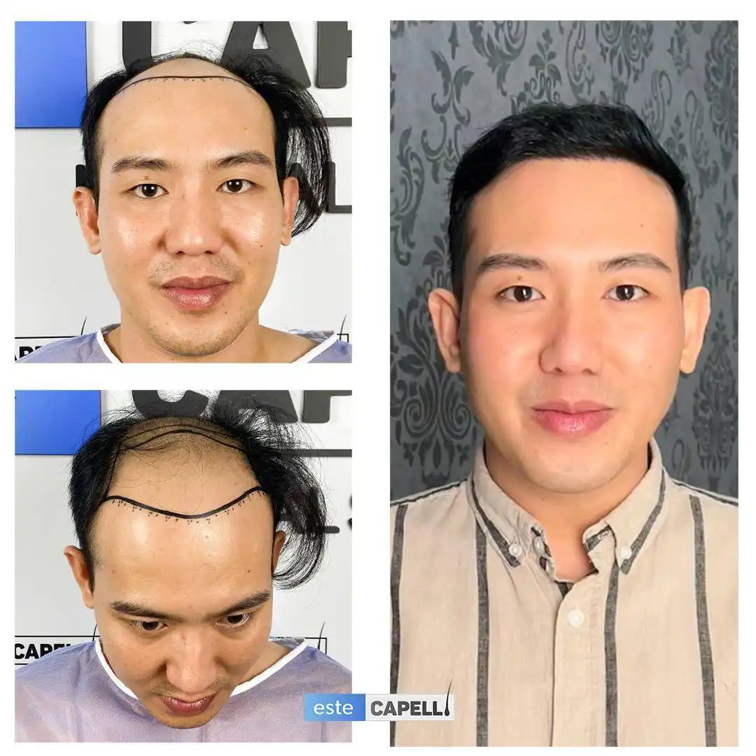 Antes y después trasplante capilar