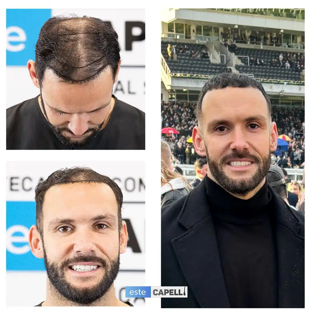 Antes y después trasplante capilar