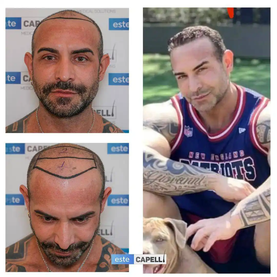 Antes y después trasplante capilar