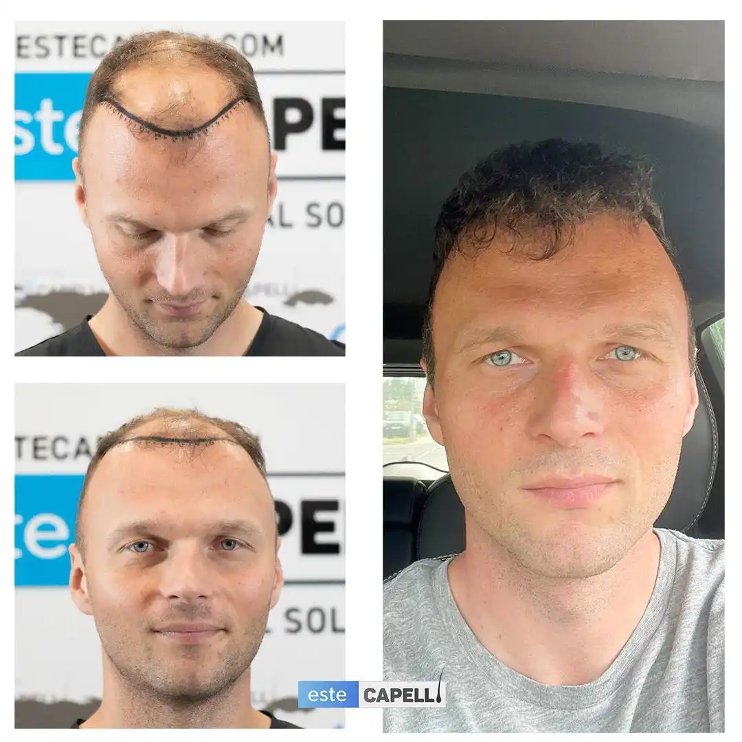 Antes y después trasplante capilar