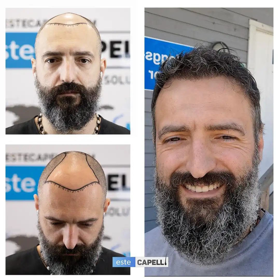 Antes y después trasplante capilar