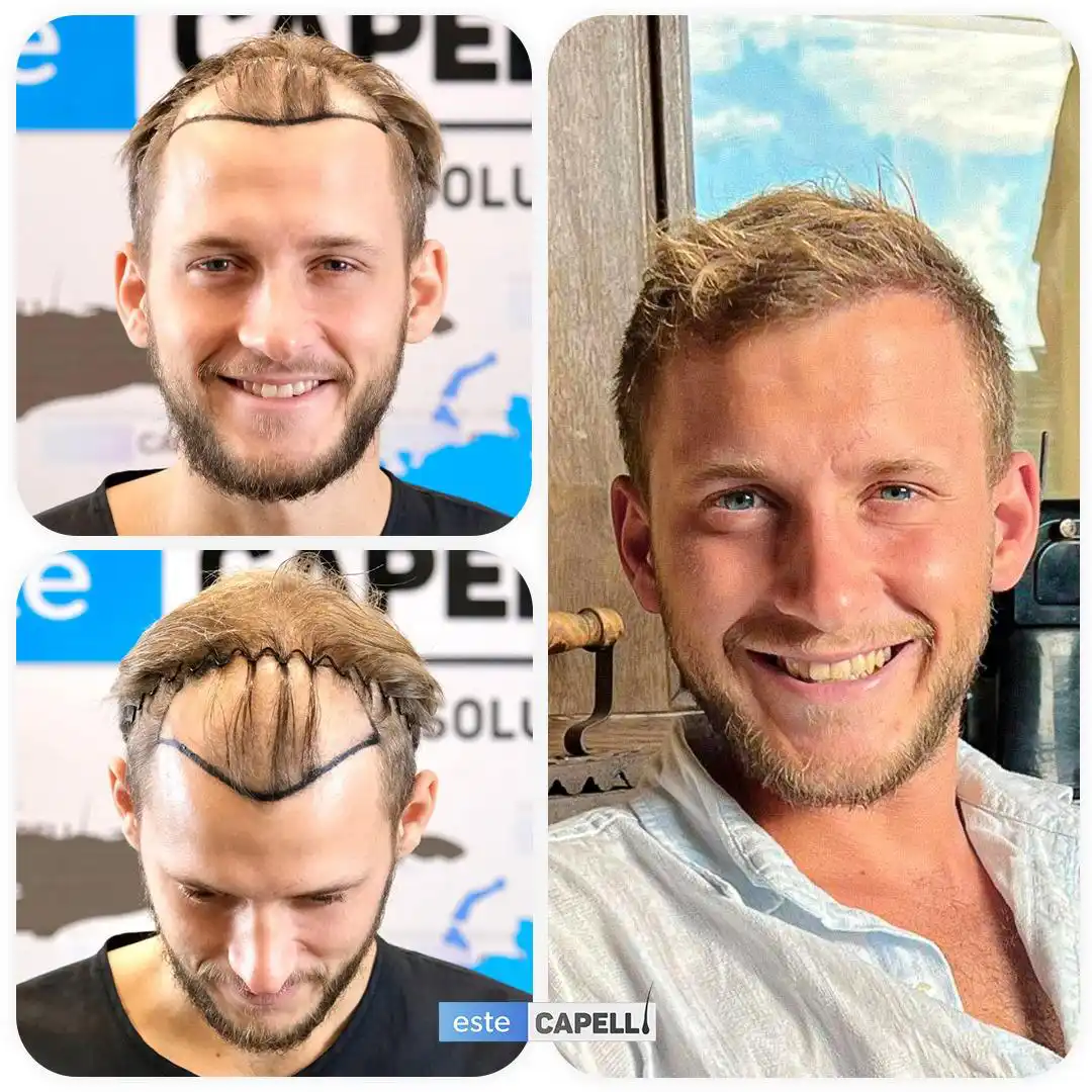 Antes y después trasplante capilar