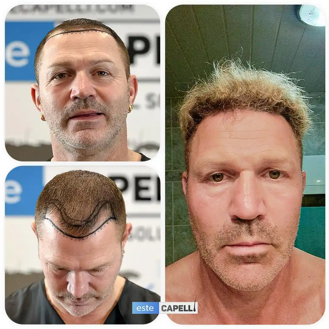 Antes y después trasplante capilar
