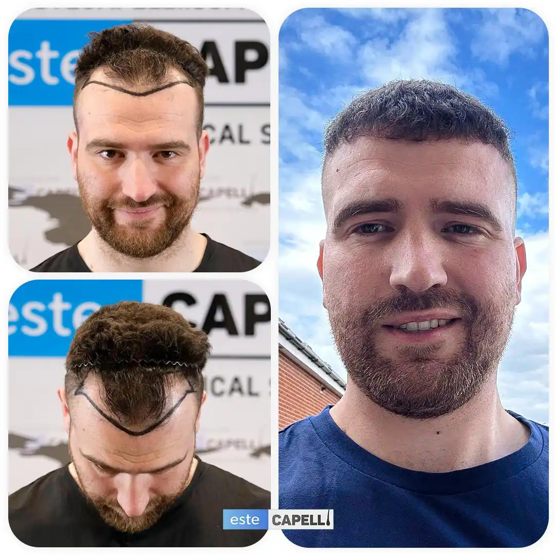 Antes y después trasplante capilar