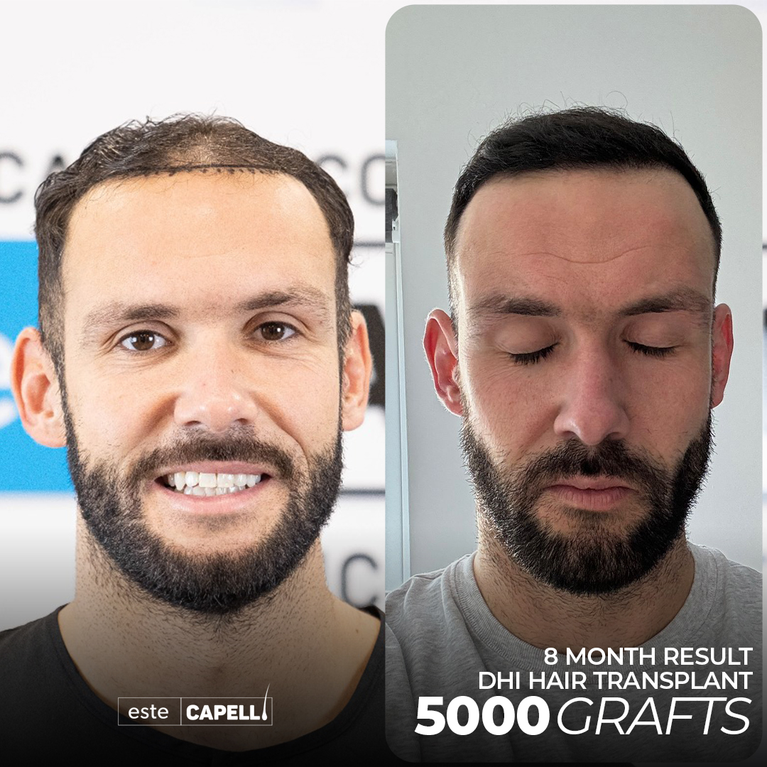 Recuperación de Trasplante de Cabello 8 hair transplant turkey miami 1