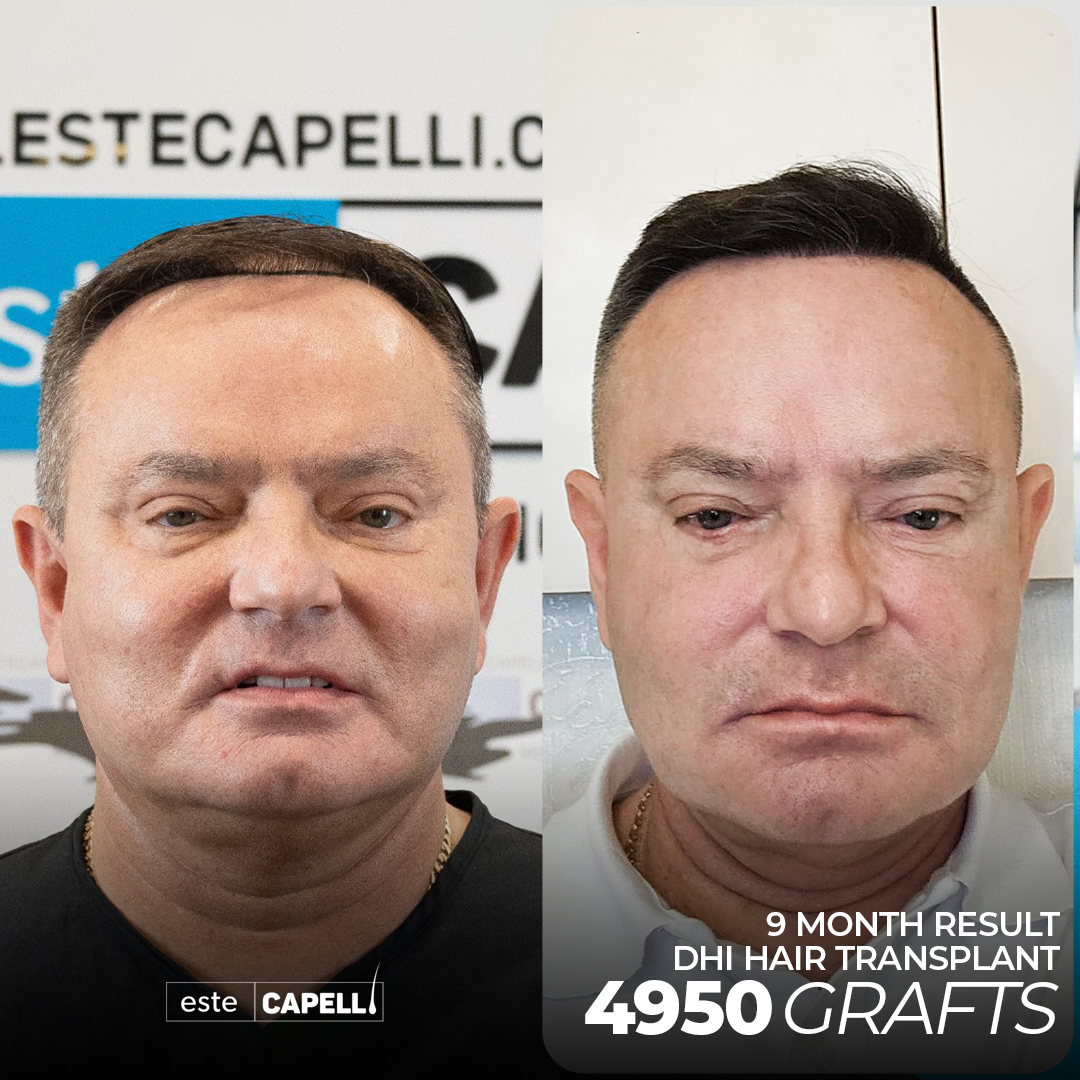 Recuperación de Trasplante de Cabello 9 hair transplant turkey miami 2