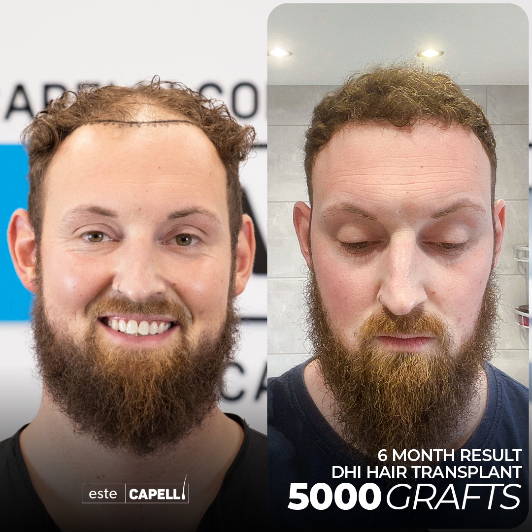Recuperación de Trasplante de Cabello 10 hair transplant turkey miami 3
