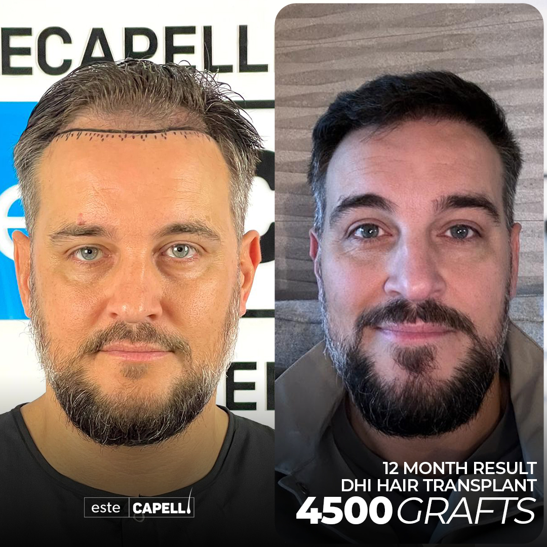 Recuperación de Trasplante de Cabello 12 hair transplant turkey miami 5