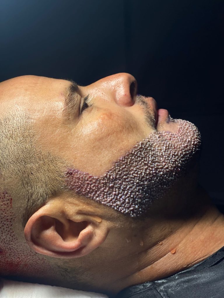 Are You The Right Candidate for Beard Transplantation