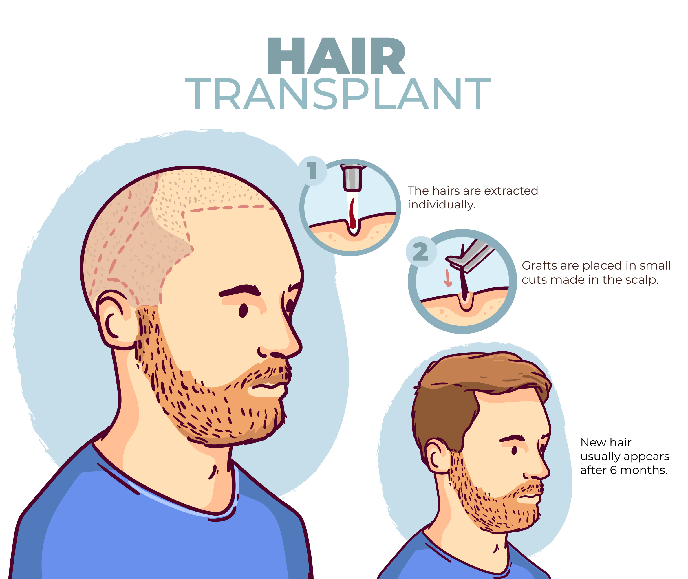Trasplante de Cabello 1 Hairtransplant 1