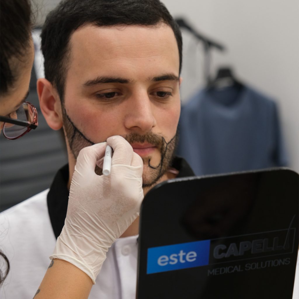 advantages and risks of a beard transplant​