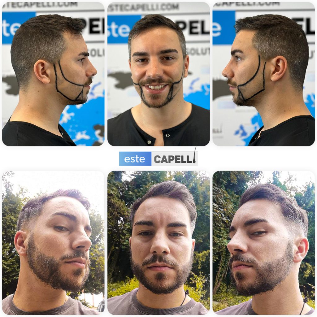 Trasplante de Barba 11 beard transplant recovery what to expect after your procedure