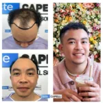 Male Hair Transplant 4