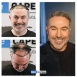 Male Hair Transplant 16
