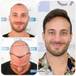 Male Hair Transplant 15