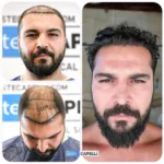 Male Hair Transplant 14