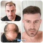 Male Hair Transplant 12