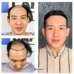 Male Hair Transplant 10