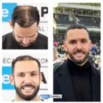 Male Hair Transplant 9