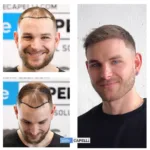 Male Hair Transplant 8