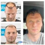 Male Hair Transplant 7