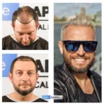 Male Hair Transplant 6