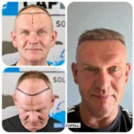 Male Hair Transplant 21