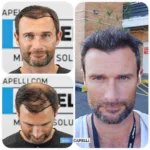Male Hair Transplant 17