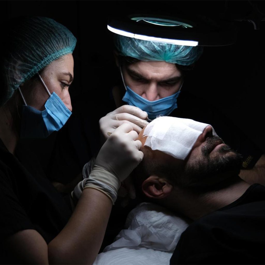 Recuperación de Trasplante de Cabello 2 Estecapelli Hair Transplant Recovery What to Expect After Your Procedure
