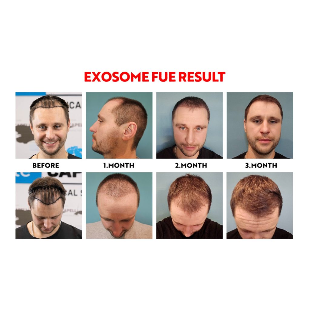 Trasplante Capilar Exosomas FUE 12 Exosome FUE Hair Transplant Recovery What to Expect After Your Procedure2