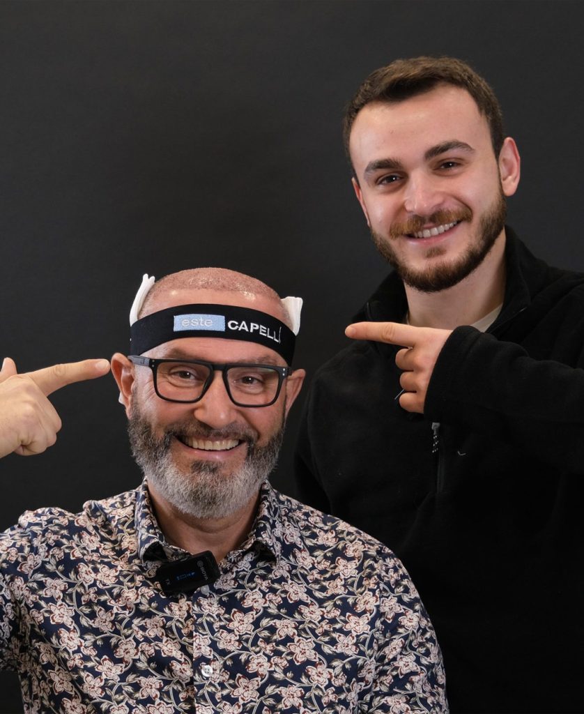 Trasplante de Cabello FUE 4 FUE Hair Transplant Recovery What to Expect After Your Procedure2
