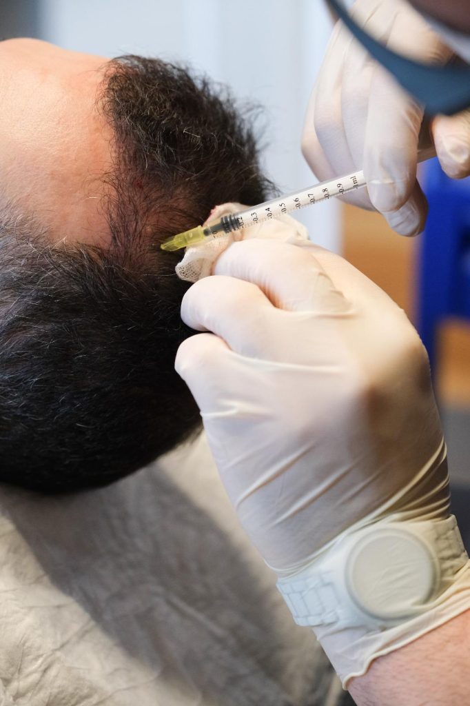 Mesoterapia Capilar 2 Hair Mesotherapy Treatment in Miami and istanbul Benefits and Procedure Overview
