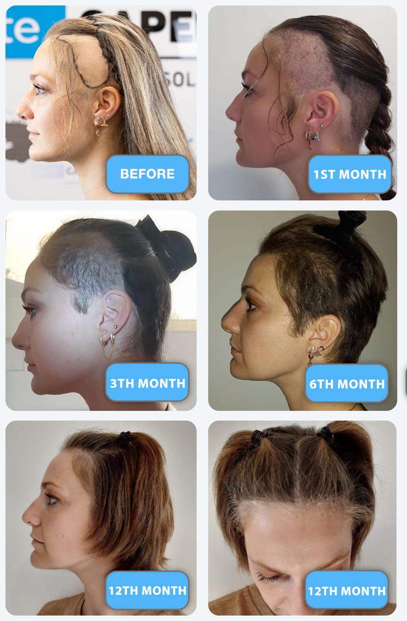 Trasplante Capilar Femenino 10 Hair Transplant Recovery Process for Women