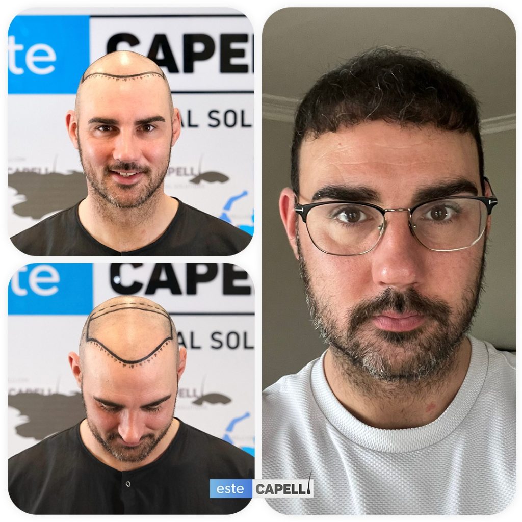 Recuperación de Trasplante de Cabello 6 Hair Transplant Recovery When Will You See Results