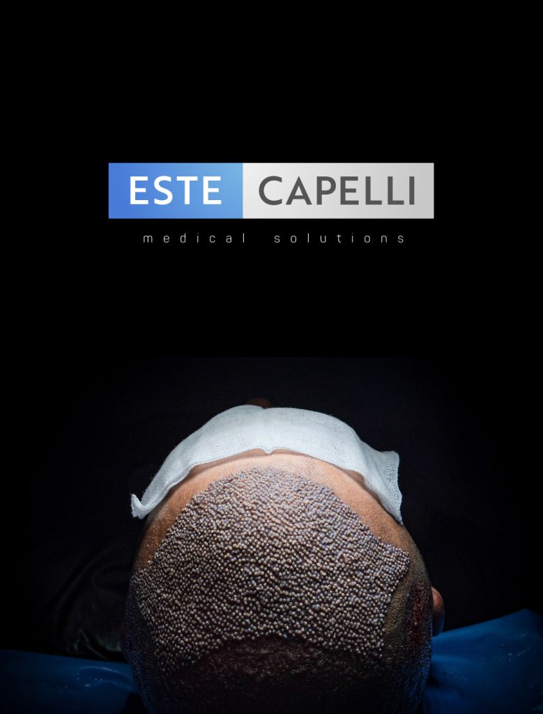 Trasplante de Cabello FUE 3 Hair Transplant in Istanbul and Miami What to Consider for Your FUE Procedure2 5