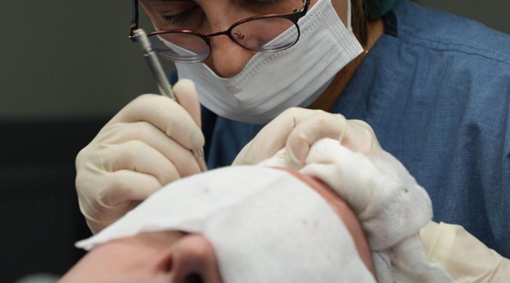 Trasplante Capilar Sapphire FUE 1 Sapphire FUE Hair Transplant3