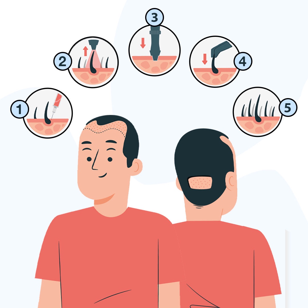 FUE Vita 7 Stages of the FUE VITA Technique