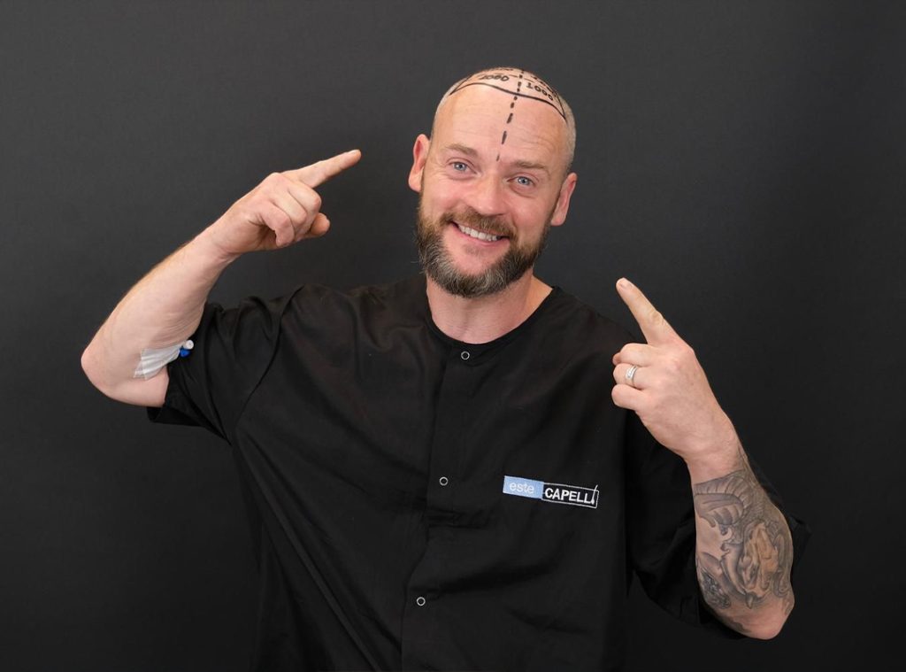 Trasplante de Cabello FUE 1 What is FUE Hair Transplantation A Comprehensive Guide For you 1
