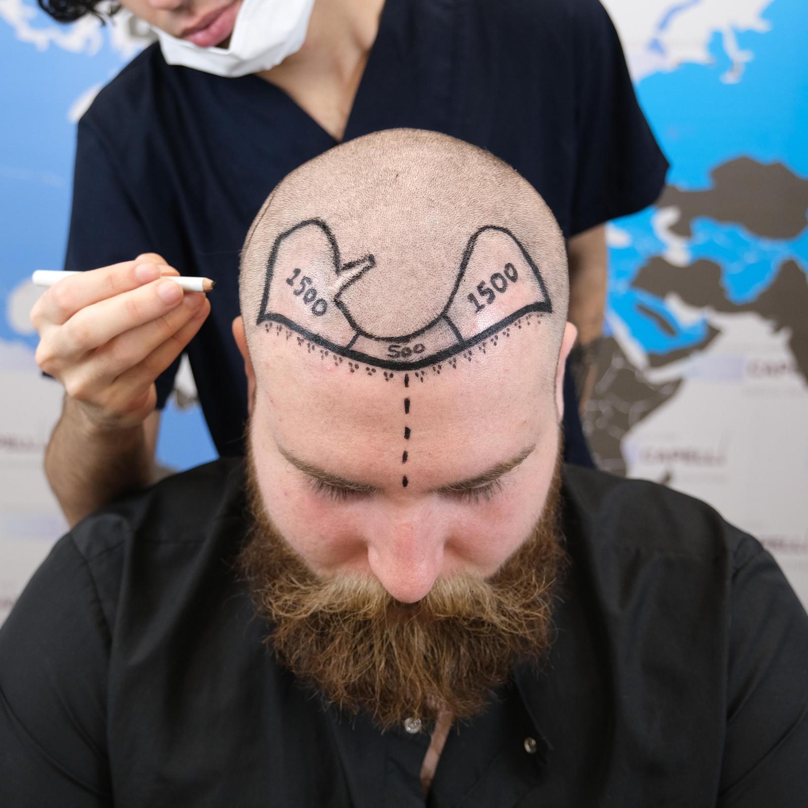 What-is-a-Hair-Transplant