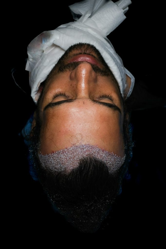 DHI Vita 3 Why Do Grafts Weaken After the Extraction