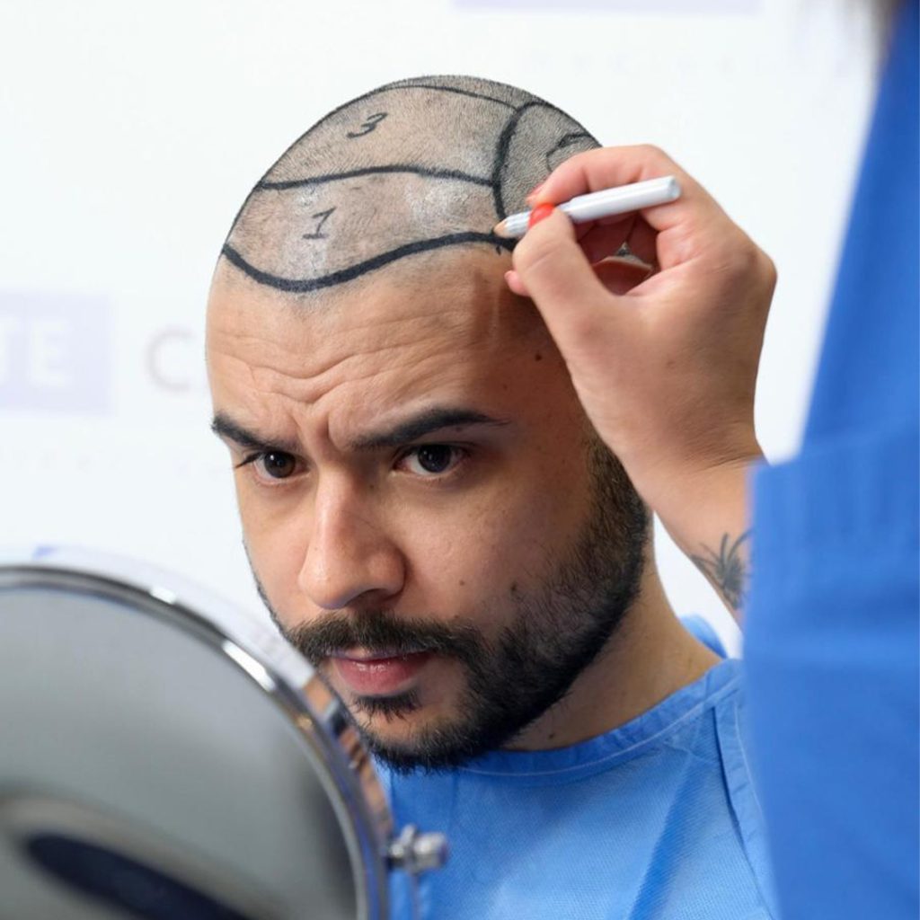 Trasplante Capilar Exosomas FUE 11 Why Exosome FUE is the Future of Hair Transplant Esteacapellis Leading Technique2