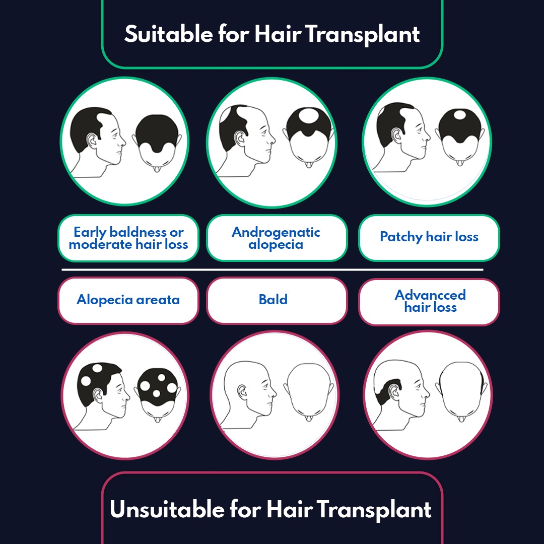 Trasplante de Cabello 3 are you a suitable candidate for hair transplantation
