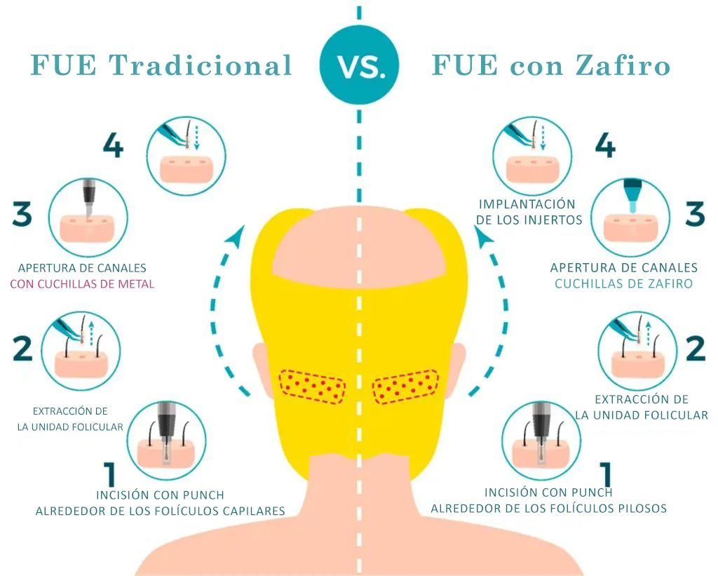 Trasplante Capilar Sapphire FUE 6 What are the differences between sapphire fue and fue