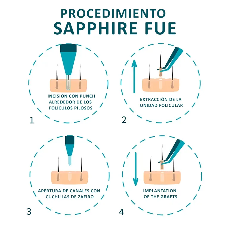 Trasplante Capilar Sapphire FUE 2 What is Sapphire FUE Hair Transplant