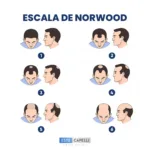 Escala de Norwood 2026: Guía Completa y Mejor Análisis