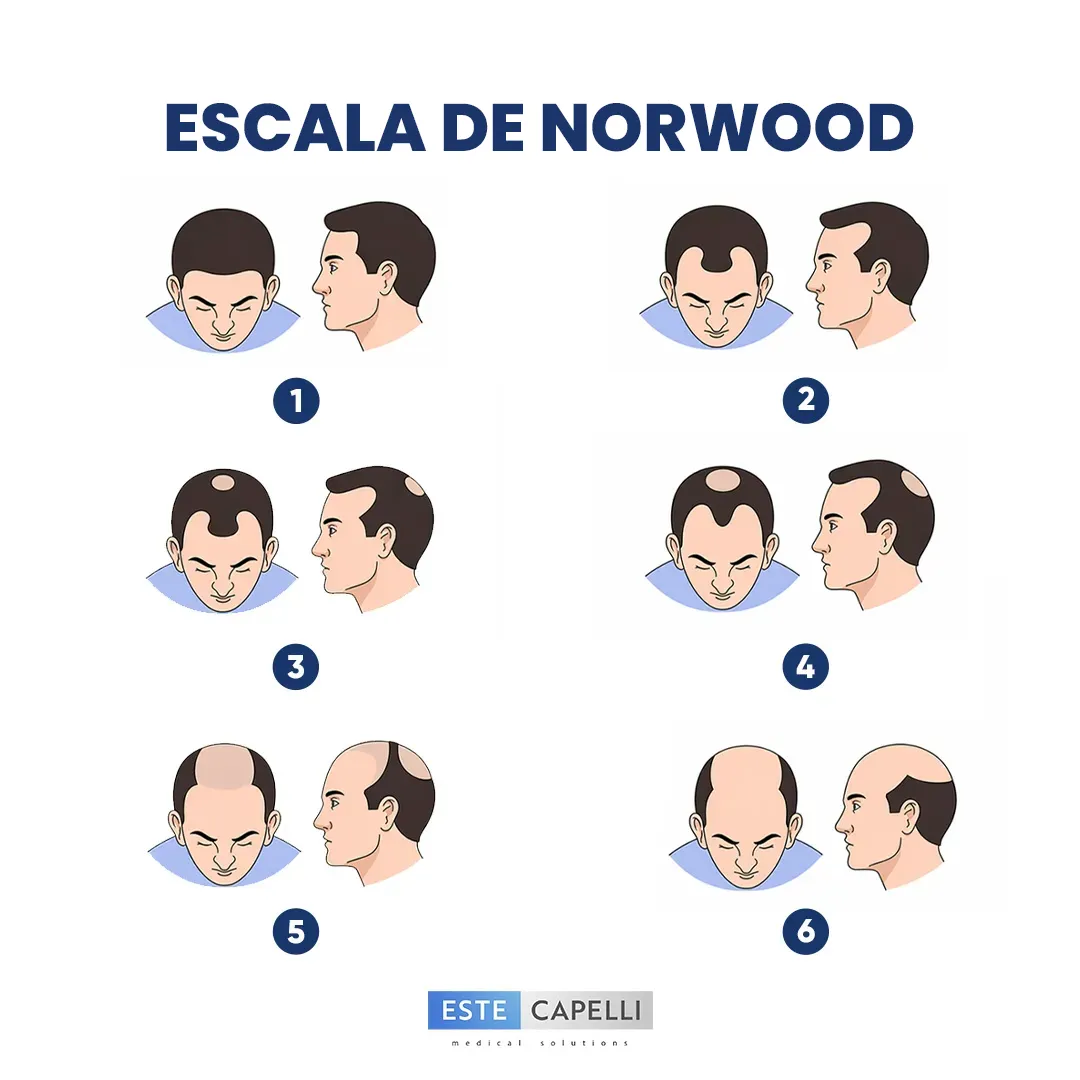escala de norwood